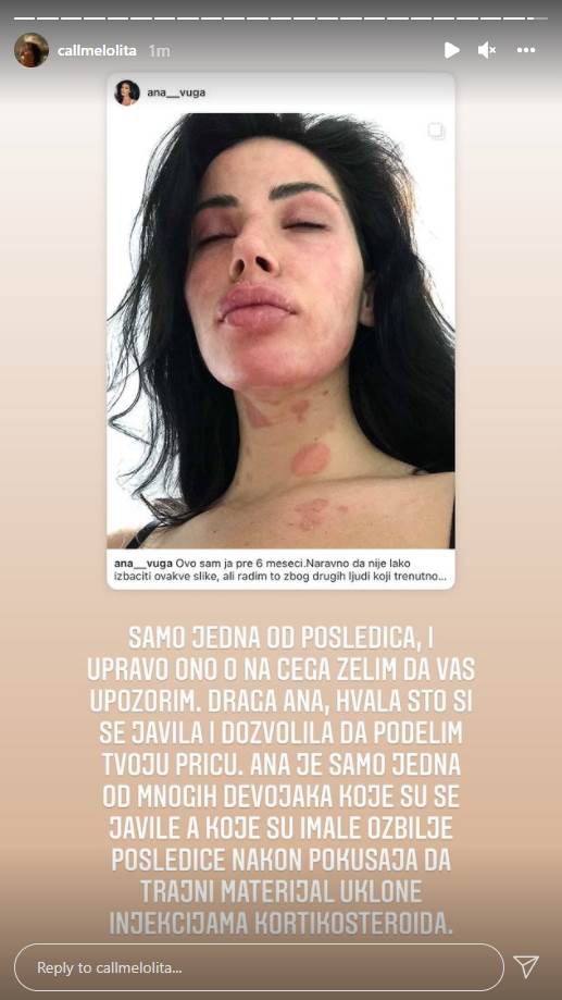  Jovana Đorđević dobila poruke devojaka koje su imale komplikacije nakon stavljanja silikona. 