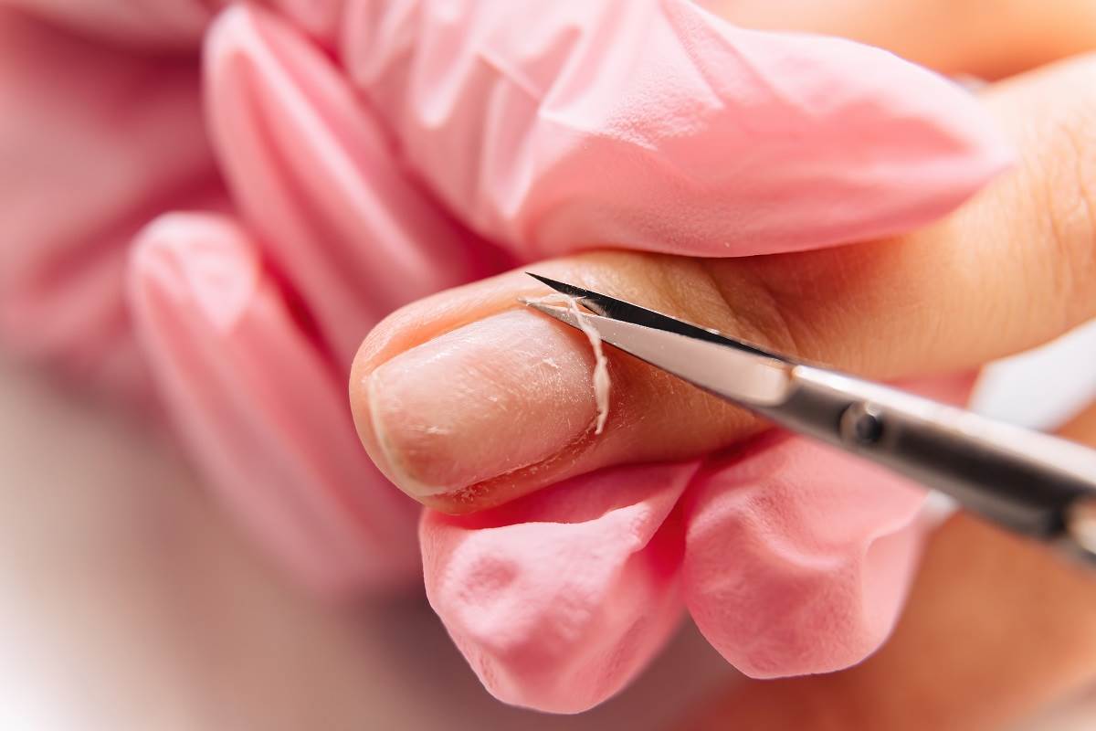  Seckanje zanoktica može da izloži vaše nokte brojnim infekcijama. 