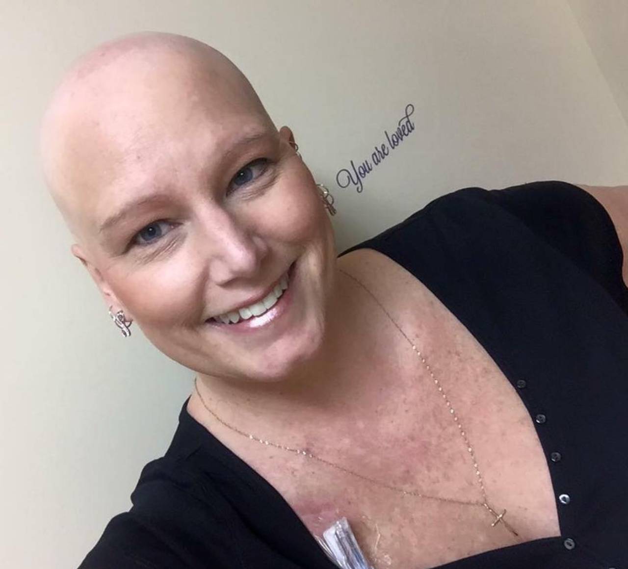  Neke žene izgube kosu nakon borbe sa rakom. 