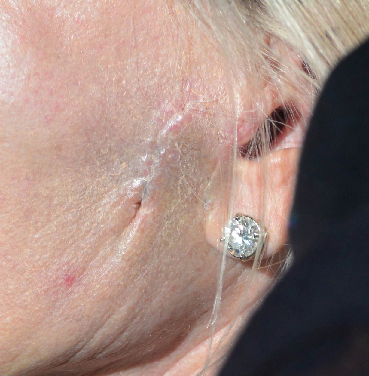  Melani Grifit ima ožiljak kraj uha. 