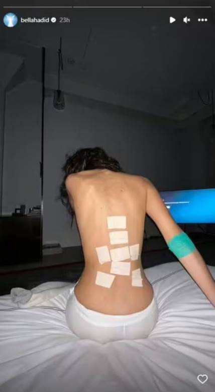 Bela Hadid pokazala kako joj telo izgleda nakon borbe sa borelijom