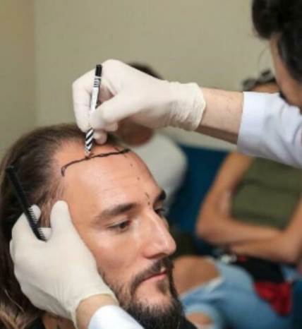 Nemanja Gudelj je pokazao kako izgleda procedura presađivanja kose.