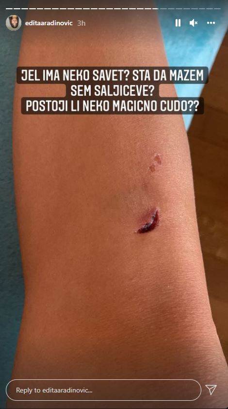 edita aradinovic povredila noge
